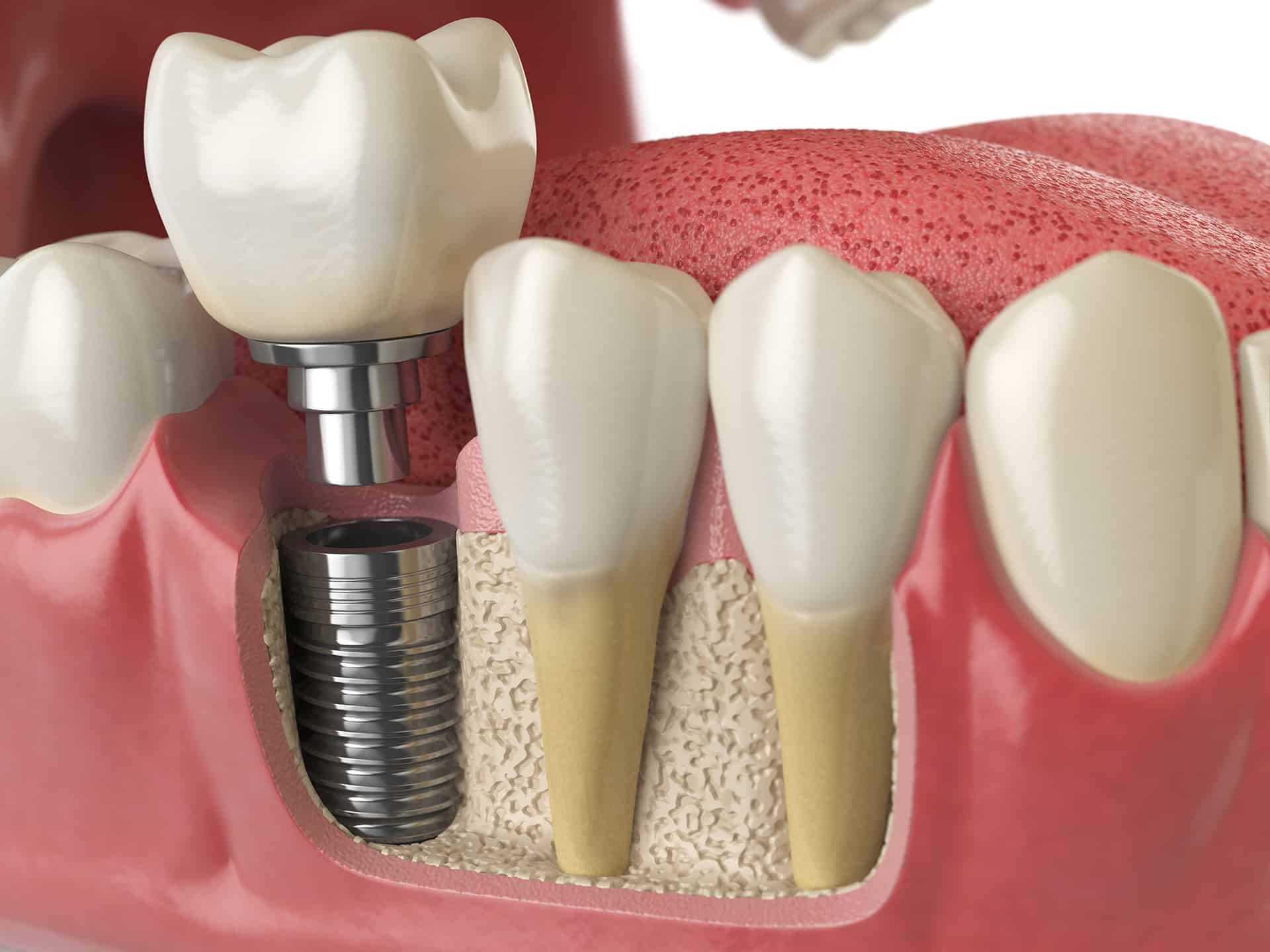 Are Same-Day Dental Implants Realistic? Weighing the Pros and Cons